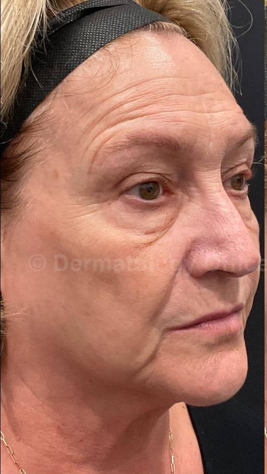 IPL-Photofacial/BBL BroadBand Laser Case-12 Before