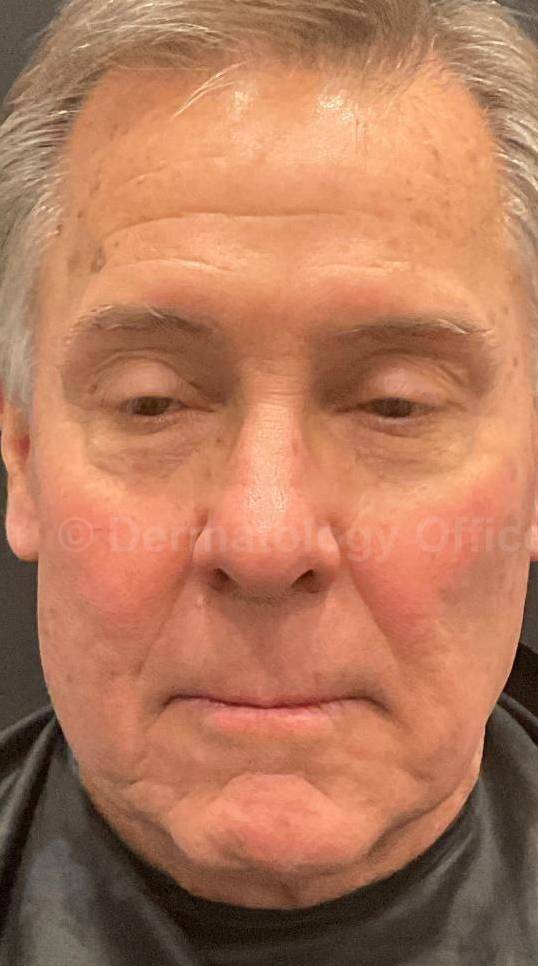 Picocare 450 Before and After Case-9 Before