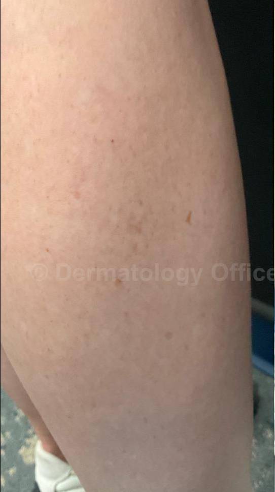 Picocare 450 Before and After Case-8 Before