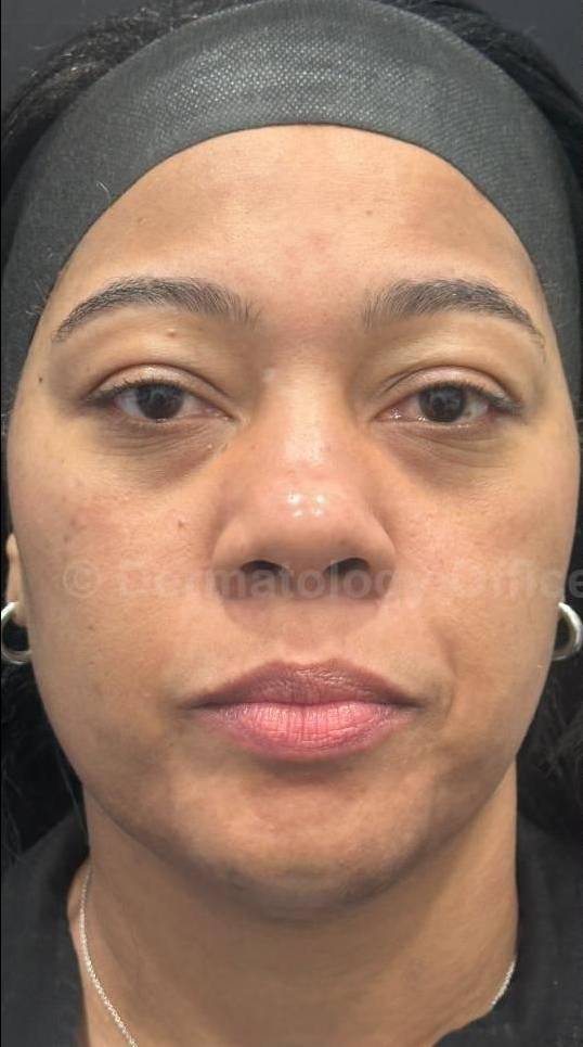 Picocare 450 Before and After Case-7 Before