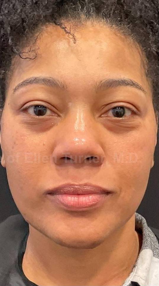 Picocare 450 Before and After Case-7 After