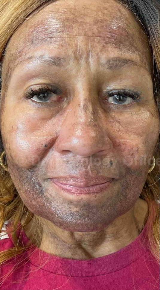 Picocare 450 Before and After Case-6 Before