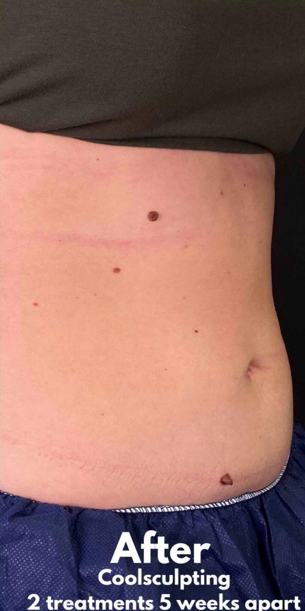 CoolSculpting<sup>&reg;</sup> Before and After Case 14 After