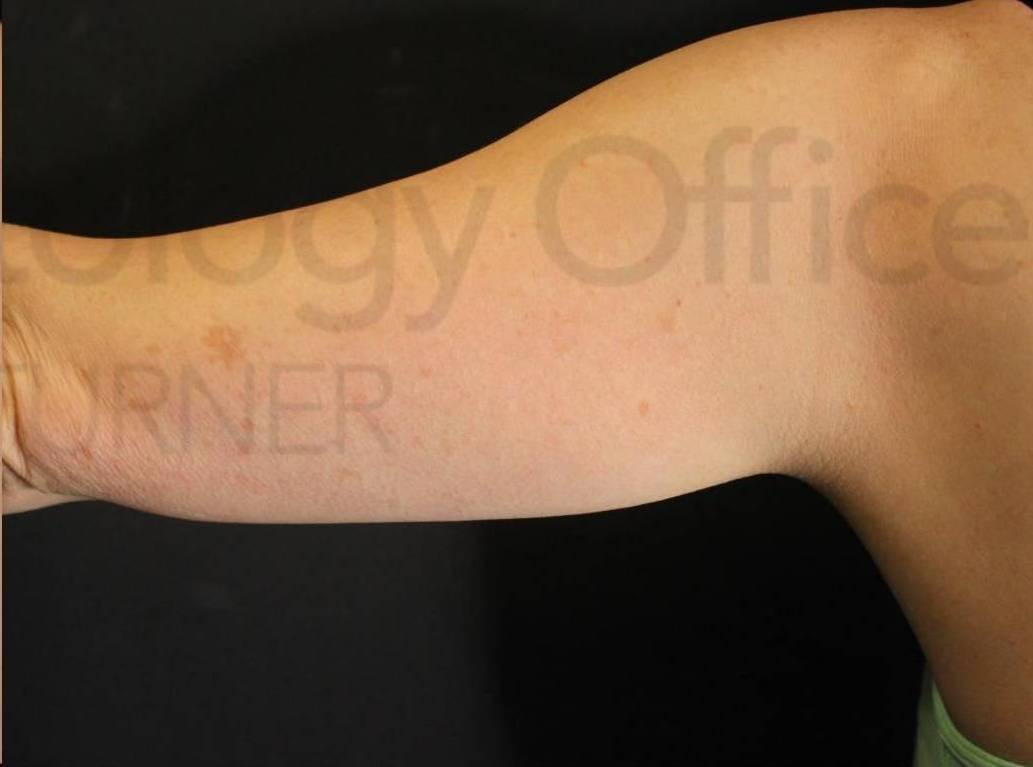 CoolSculpting Elite (2 Treatments) Case-2 After