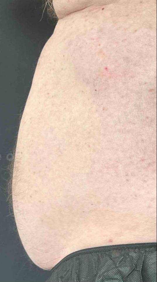 EMSculpt Neo (6 Treatments) Case-6 After