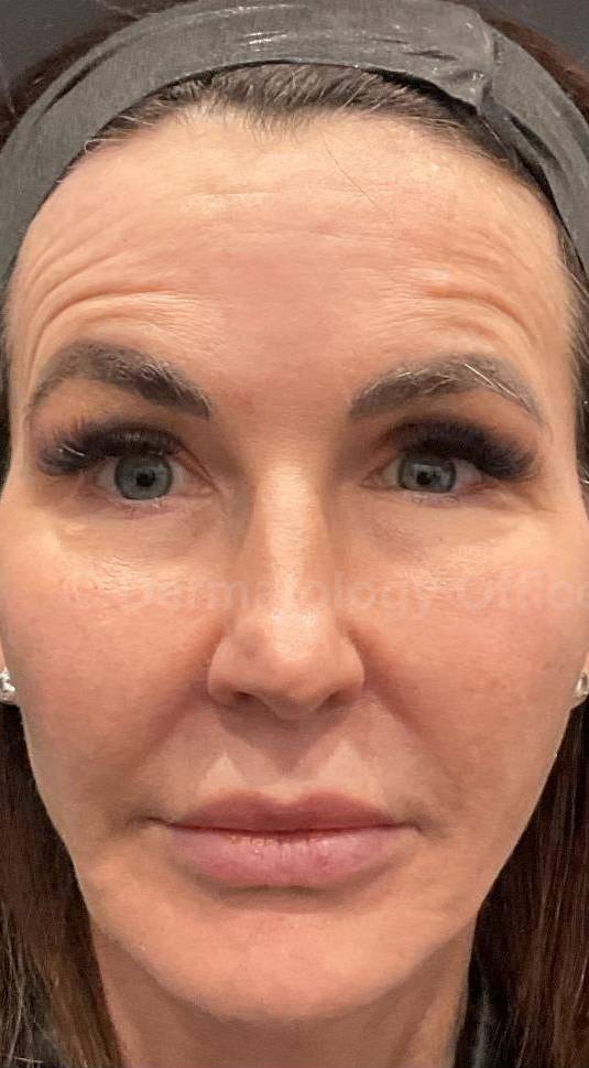 EMFACE Before and After- 16 Before