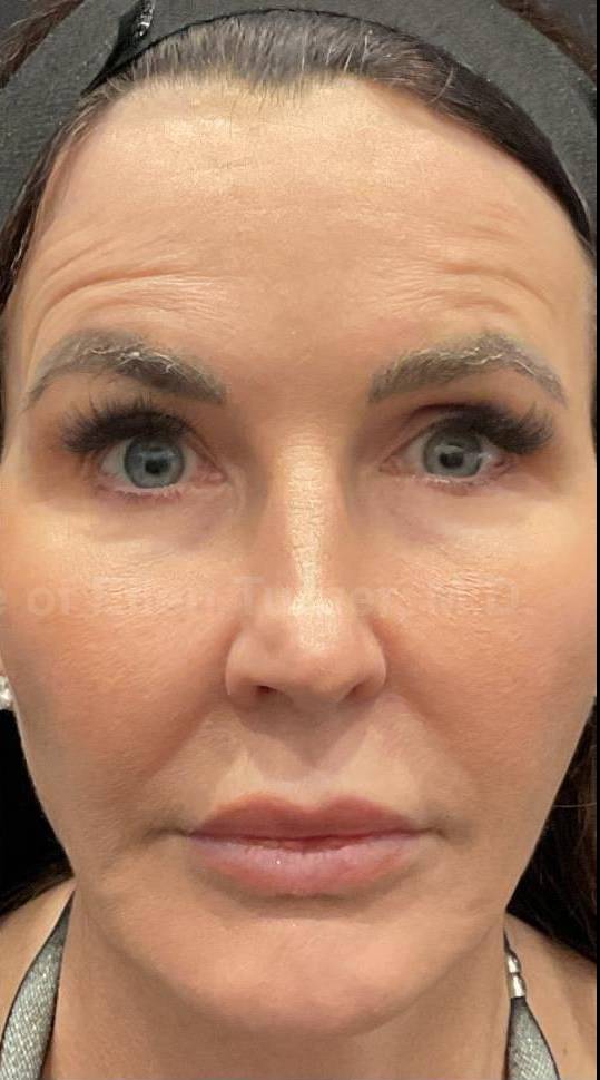 EMFACE Before and After- 16 After