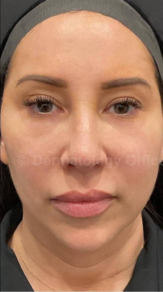 EMFACE Before and After- 17 Before