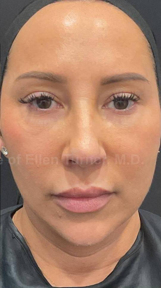 EMFACE Before and After- 17 After