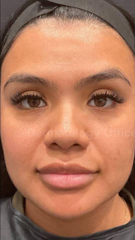 EMFACE Before and After- 18 Before