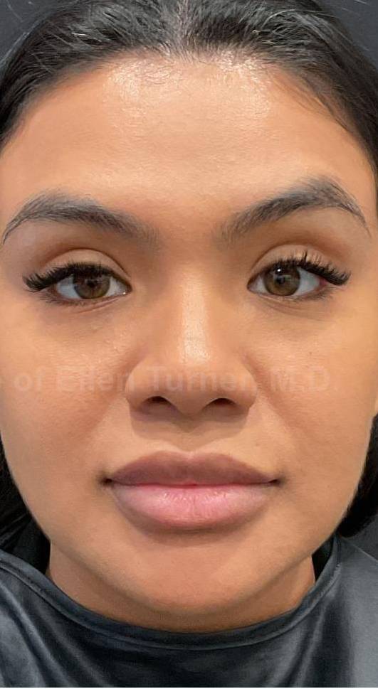 EMFACE Before and After- 18 After