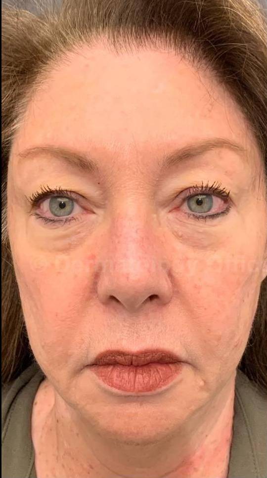 EMFACE Before and After- 19 Before