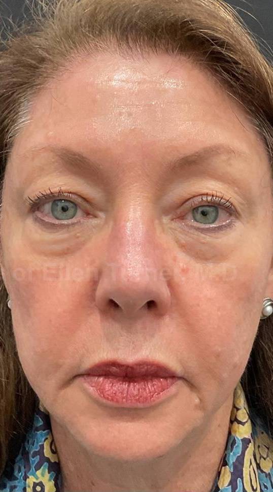 EMFACE Before and After- 19 After