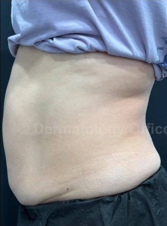 Exion HA Before and After Case 2 Before