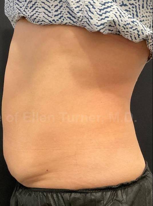 Exion HA Before and After Case 2 After