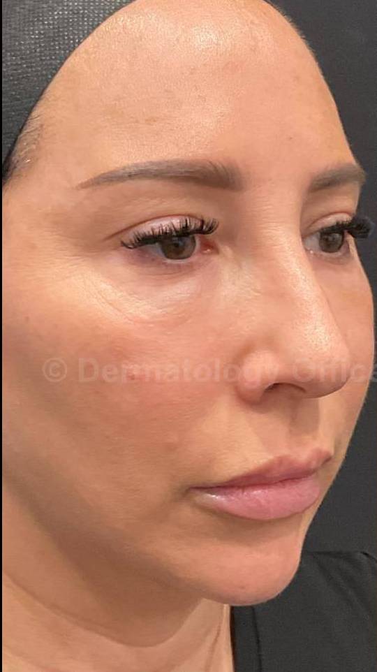 Silhouette Instalift Before and After Case-14 Before