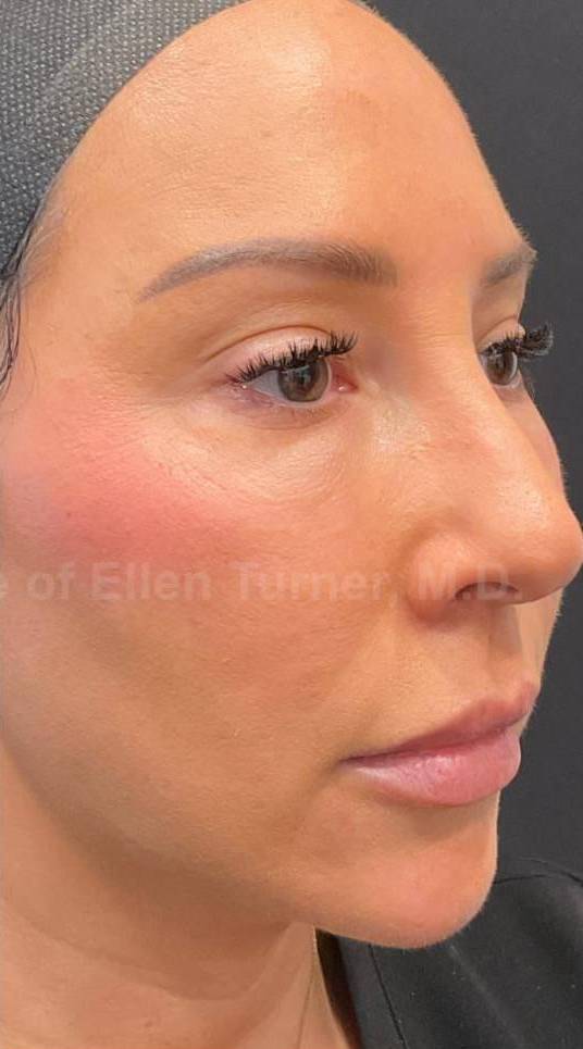 Silhouette Instalift Before and After Case-14 After