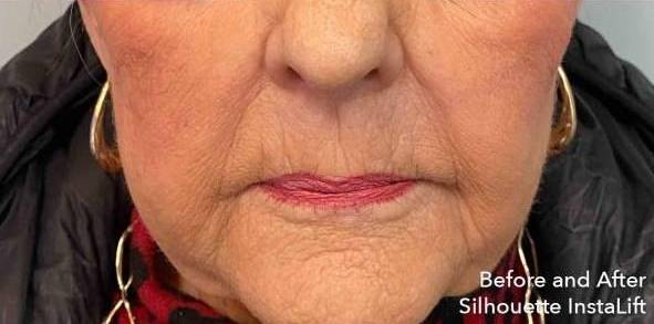 Silhouette InstaLift Before and After Case 4 After