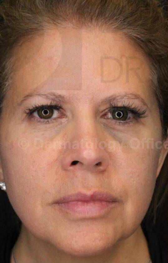 Silhouette InstaLift (8 Strings) Case-12 Before