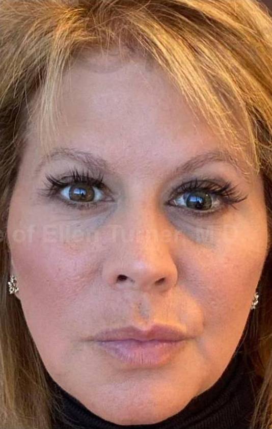 Silhouette InstaLift (8 Strings) Case-12 After