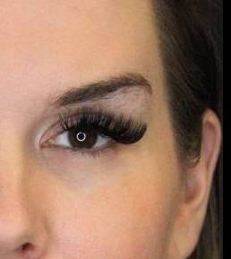 Sculptra (1 vials) Case 3 After