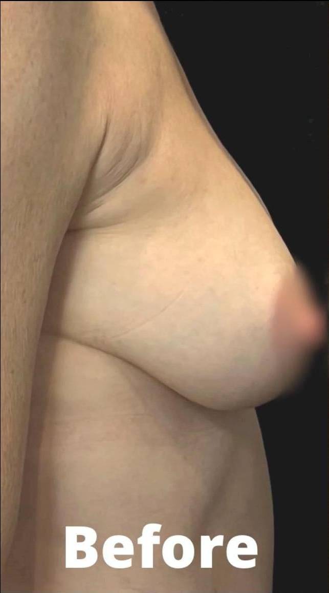 Silhouette InstaLift Before and After Case-13 Before