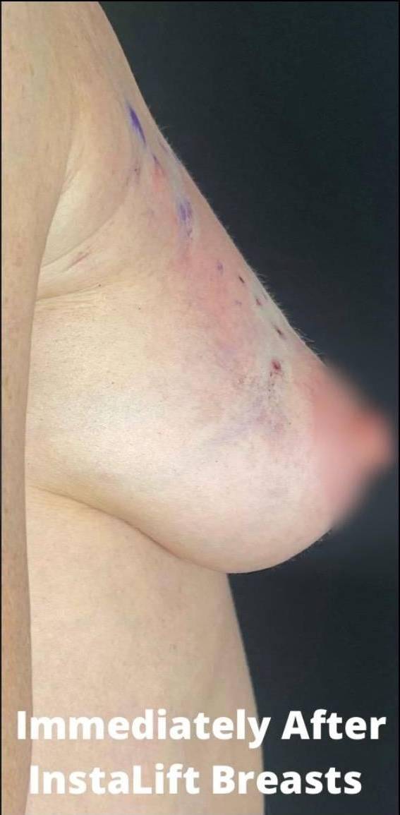 Silhouette InstaLift Before and After Case-13 After