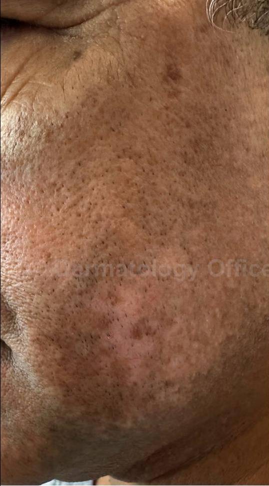 Before and After Vitiligo Case 4 Before