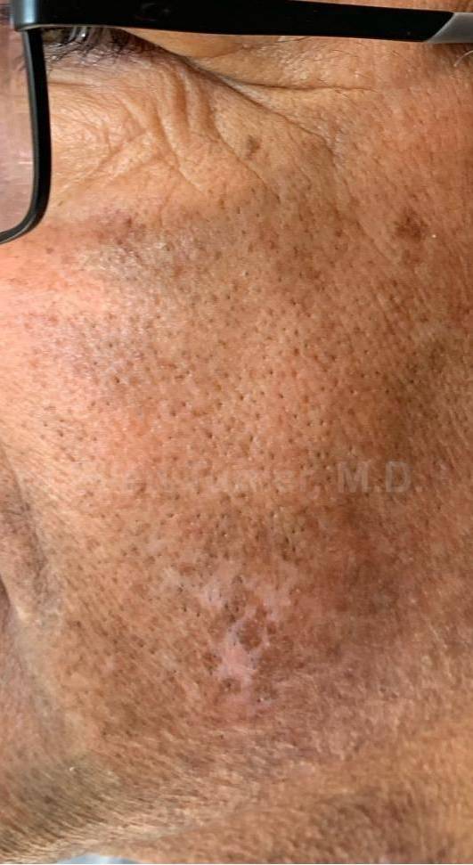 Before and After Vitiligo Case 4 After