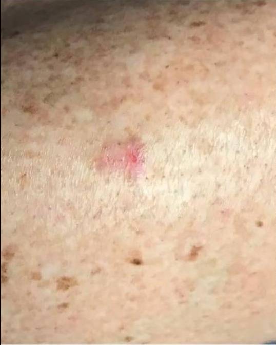 SRT-100 Before and After Case 1 Before