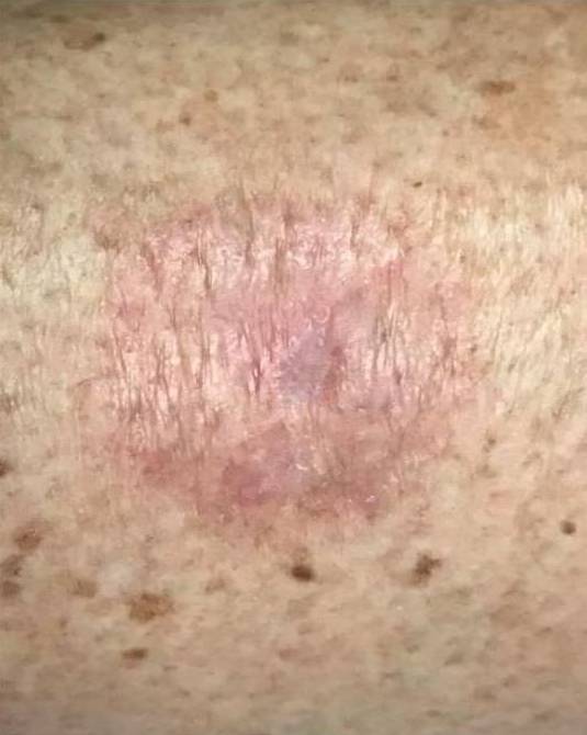 SRT-100 Before and After Case 1 After