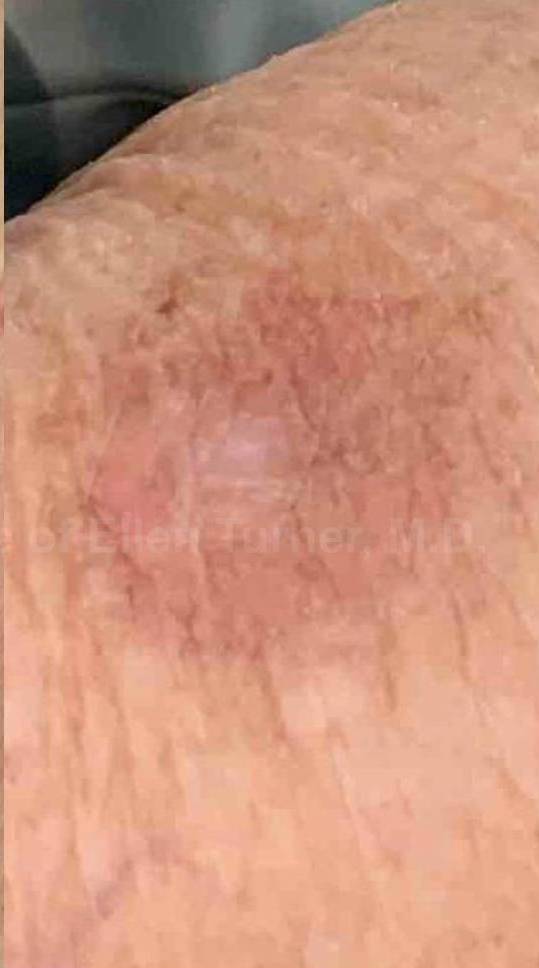 SRT-100 Before and After Case 3 After