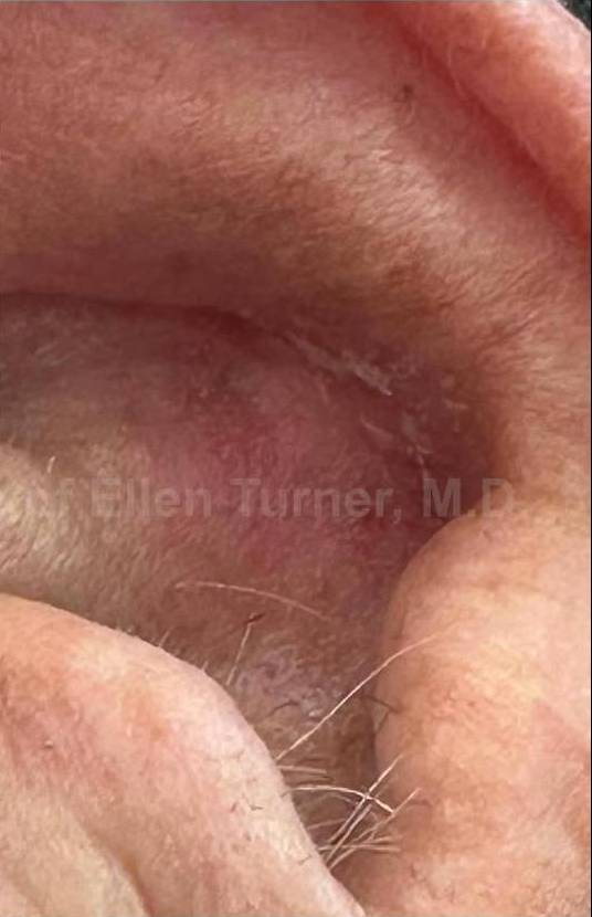 SRT-100 Before and After Case 4 After