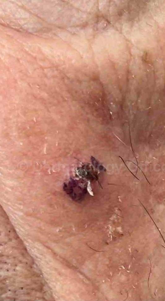 SRT-100 Before and After Case 5 Before