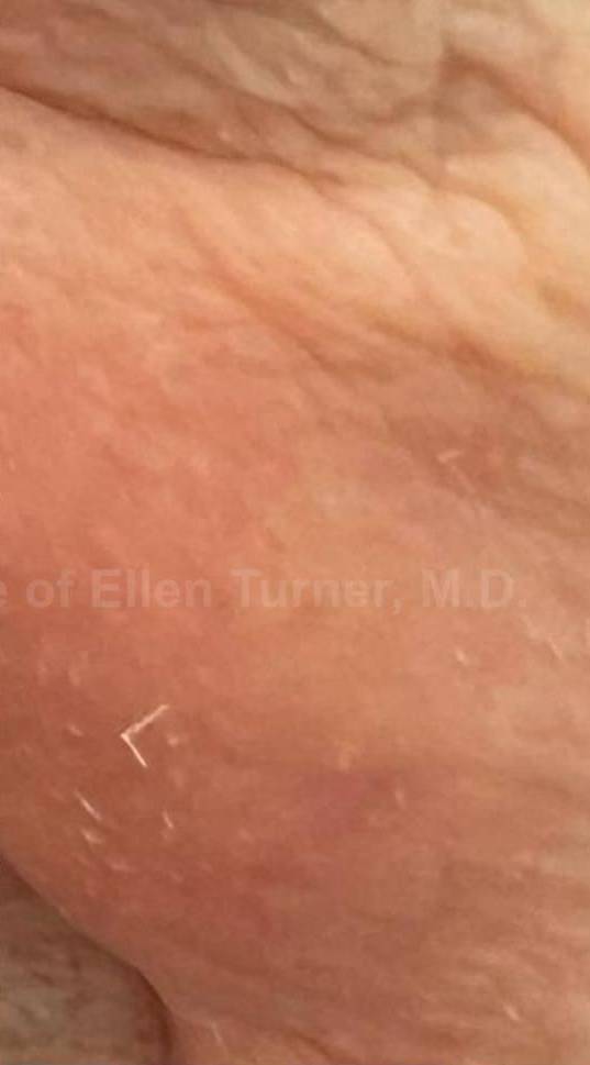 SRT-100 Before and After Case 5 After