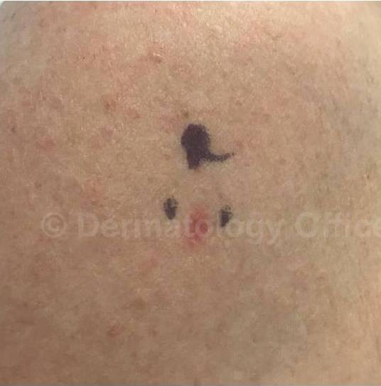 SRT-100 Before and After Case 6 Before