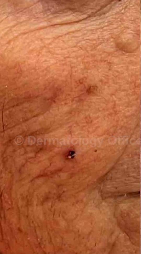 SRT-100 Before and After Case 7 Before