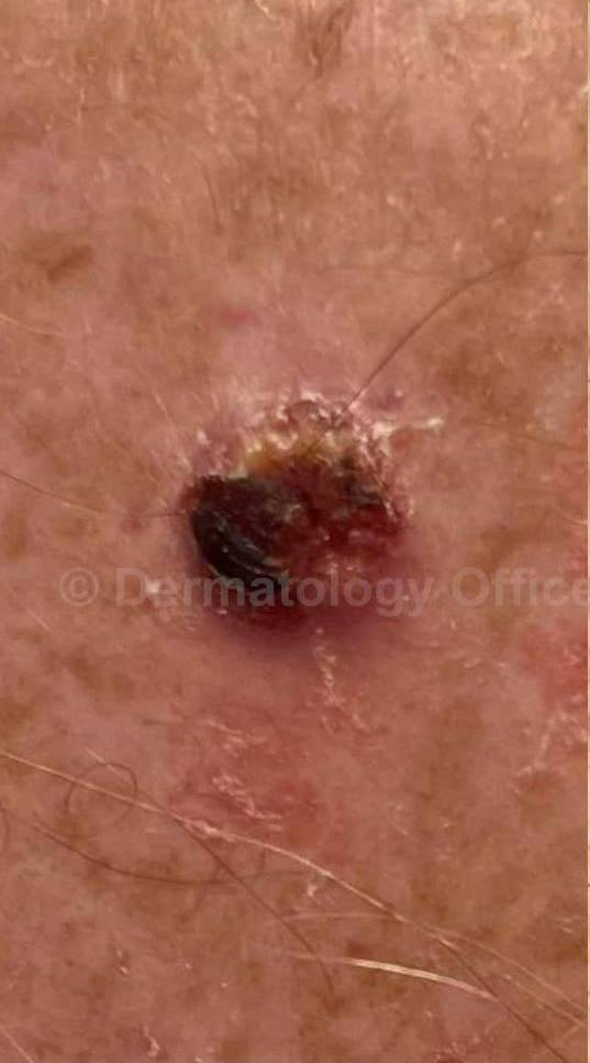 SRT-100 Before and After Case 9 Before