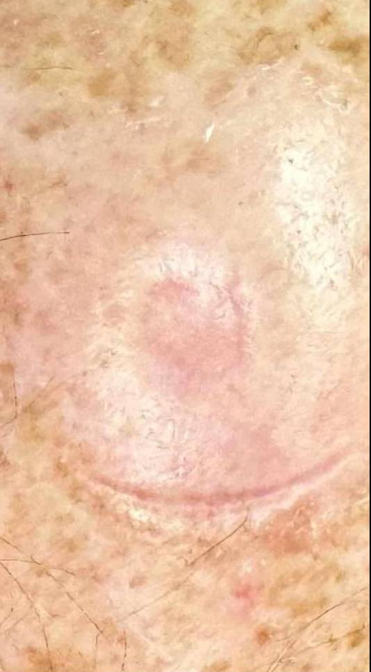 SRT-100 Before and After Case 9 After