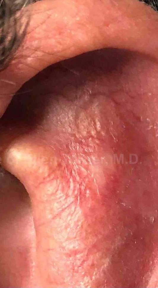 SRT-100 Before and After Case 10 After