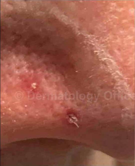 SRT-100 Before and After Case 11 Before