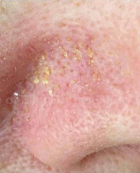 SRT-100 Before and After Case 11 After