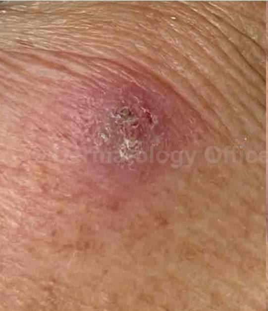 SRT-100 Before and After Case 12 Before