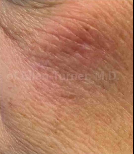 SRT-100 Before and After Case 12 After