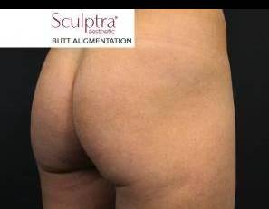 Sculptra (10 vials) Case 2 Before