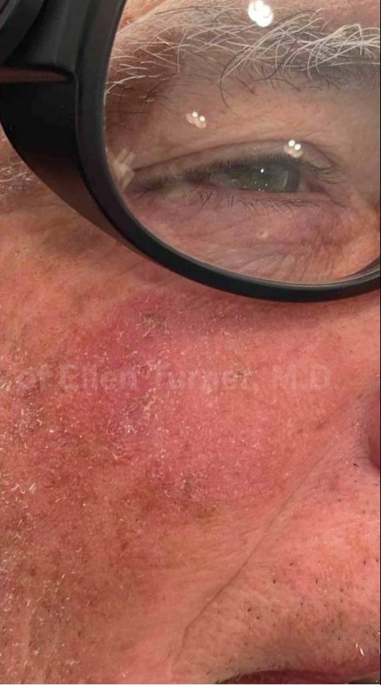 SRT-100 Before and After Case 13 After