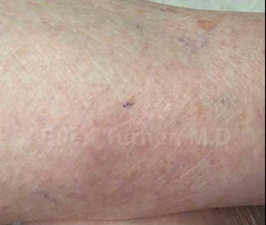 SRT-100 Before and After Case 14 After