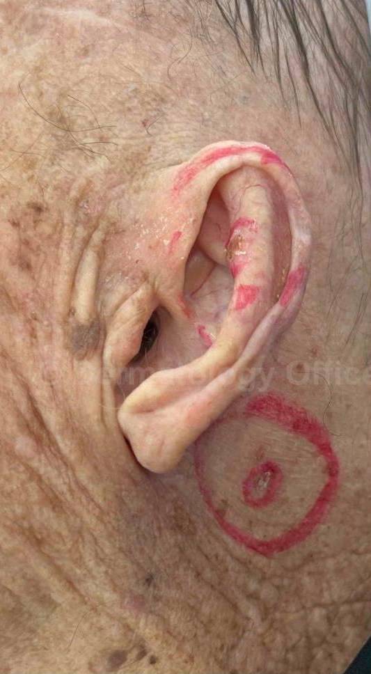 SRT-100 Before and After Case 16 Before