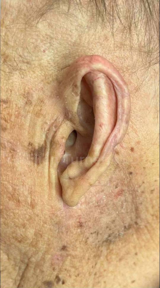 SRT-100 Before and After Case 16 After