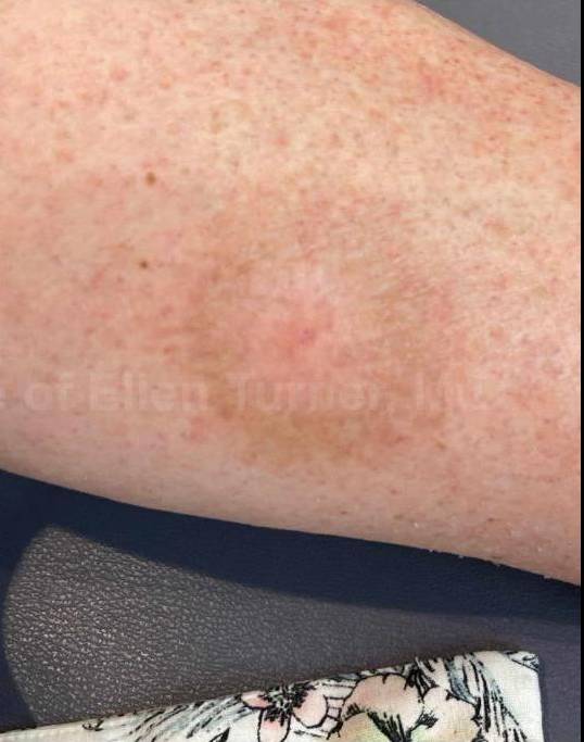 SRT-100 Before and After Case 17 After